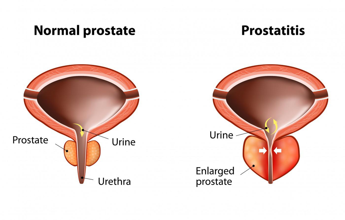 Normal prostate of a healthy man and inflammation of the prostate gland with prostatitis